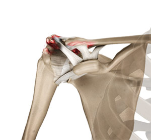 Acromioclavicular (AC) Joint