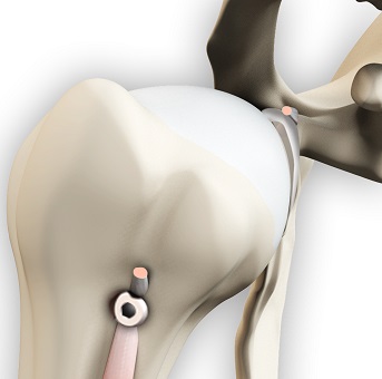 Biceps Repair and Tenodesis