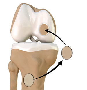 ACL Reconstruction