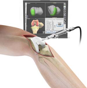 Computer navigation for Total knee replacement