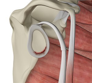 Shoulder Labral Tear