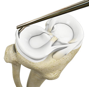 ACL Reconstruction