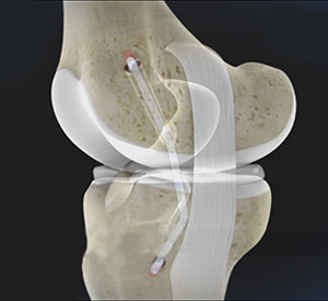 ACL Reconstruction