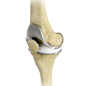 Total knee replacement